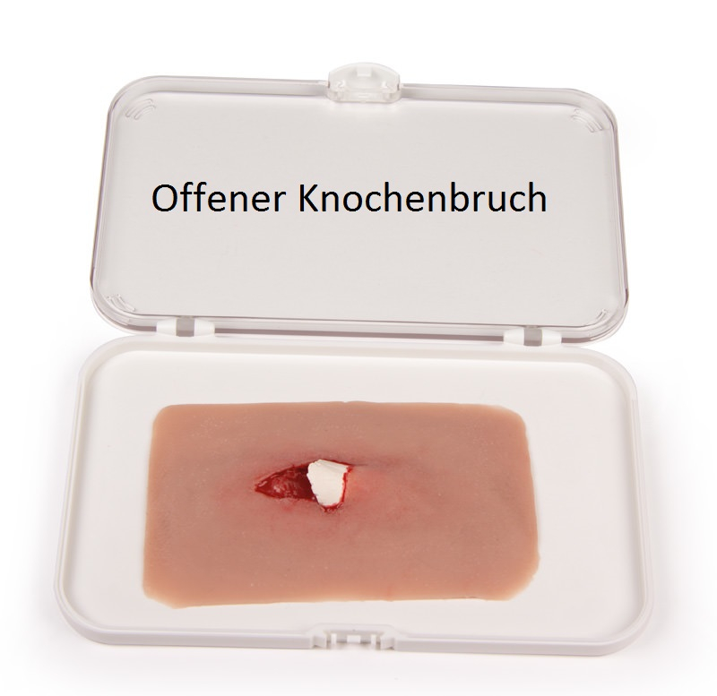 Wundmoulage offener Bruch