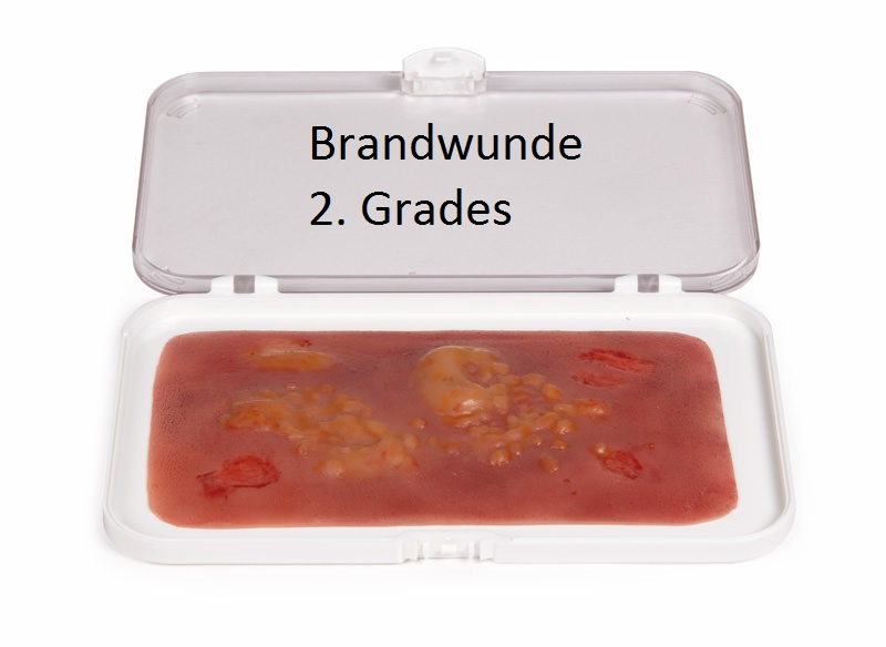 Wundmoulage Brandwunde